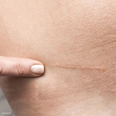 Surgical Scars and Summer: During pre-surgical consultations, patients often express concerns about how to deal with new surgical scars. This is especially top of mind in the summer when they want to go out but worry about scars being visible and having sun exposure. Click on the link below to read a few suggestions. Sekijiro Kan, General Anaesthesia, Skincare For Oily Skin, Plastic Surgery Procedures, Heart Healthy Diet, Injectables Fillers, Scar Tissue, After Surgery, Dermal Fillers