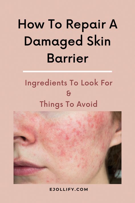 Rebuild Skin Barrier, How To Know If Your Skin Barrier Is Damaged, Skin Repair Remedies, How To Fix Damaged Skin Barrier, How To Fix Skin Barrier, Moisture Barrier Skin Care, How To Restore Skin Barrier, How To Heal Skin Barrier, Heal Skin Barrier