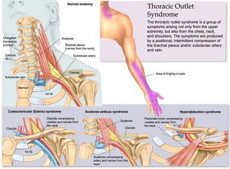 Thoracic outlet syndrome Thoracic Outlet, Massage Marketing, Physical Therapist Assistant, Hand Therapy, Massage Techniques, Nerve Pain, Massage Therapist, Reflexology, Chiropractic