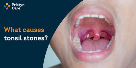 What is Swollen Tonsil? Swollen tonsils, medically referred to as tonsillitis, involve the inflammation and enlargement of the tonsils. Positioned on Bad Taste In Mouth, Swollen Tonsils, Throat Pain, Throat Infection, Strep Throat, Healthy Diet Plans, Medical Prescription, Oral Hygiene, Oral Health