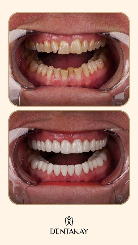 Follow us on Pinterest for more inspiring before and after photos! #zirconia #zirconiumveneers #veneersbeforeafter #crownsbeforeafter #zirconiabeforeafter #beforeafterdentaltreatment Logo Before And After, Dental Veneers Before And After, Dental Before And After, Teeth Before And After, Dental Implants Before And After, Veneers Before And After, Teeth Makeover, Dental Makeover, Loose Teeth