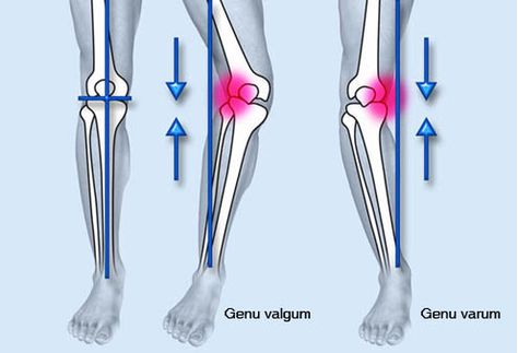 Exercises to prevent knee osteoarthritis - All topics relating to ... Leg Surgery, Best Acne Scar Removal, Bow Legged Correction, Different Types Of Acne, Knock Knees, Bow Legged, Knee Replacement Surgery, Leg Braces, Types Of Acne