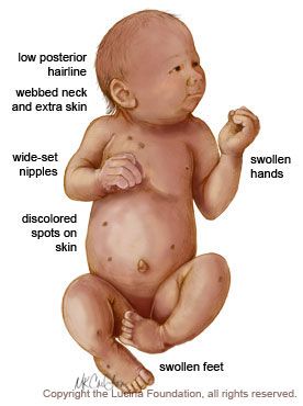 Turners syndrome Turners Syndrome, Patau Syndrome, Ob Ultrasound, Peds Nursing, Neonatal Nursing, Newborn Nursing, Medical Sonography, Child Nursing, Diagnostic Medical Sonography