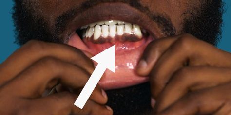 You may have noticed that some people have darker gums than others. Dr. Jonathan Levine tells us why. Sore Gums Remedy, Dark Gums, Health And Fitness Expo, Point Acupuncture, Turmeric Vitamins, Dark Spots On Face, Nutrition Drinks, Receding Gums, Healthy Benefits