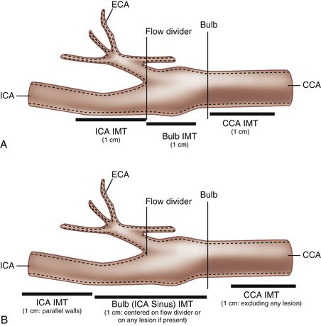 Carotid Artery Ultrasound, Carotid Ultrasound, Human Anatomy Picture, Diagnostic Medical Sonography Student, Thyroid Ultrasound, Ultrasound School, Arteries Anatomy, Cardiac Sonography, Vascular Ultrasound