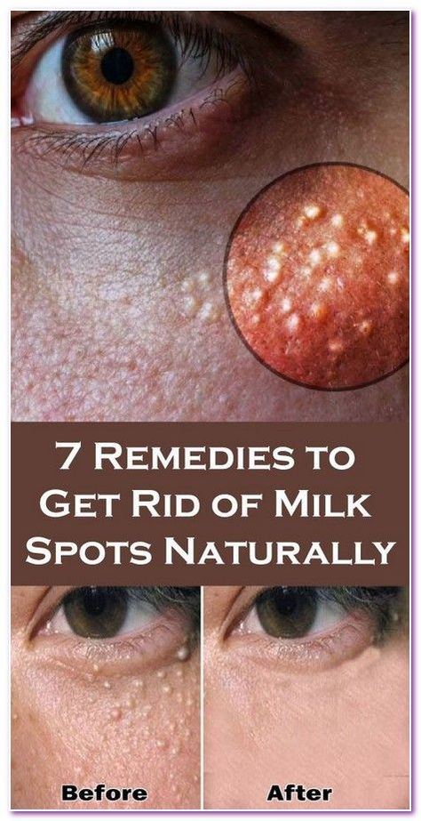 7 Remedies to Get Rid of Milk Spots Naturally Healthy Tricks, Oatmeal Scrub, Health Planner, Skin Disorders, Cosmetic Procedures, Be Healthy, Alternative Medicine, Skin Problems, Face Skin