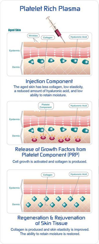 Microneedling – Dr John Burns Platelet Rich Plasma Therapy, Prp Therapy, Aesthetic Dermatology, Cosmetic Injectables, Platelet Rich Plasma, Cosmetic Dermatology, Botox Fillers, Aesthetic Medicine, Regenerative Medicine