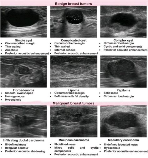 Ultrasound Abdomen Boards, Breast Ultrasound Image, Diagnostic Medical Sonography Student Notes, Ultrasound Tech Notes, Sonography Student Study, Sonogram Technician, Ultrasound Technician School, Diagnostic Medical Sonography Student, Ultrasound School