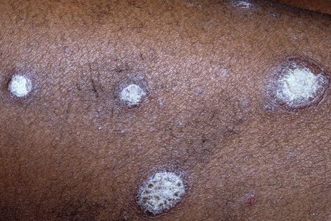 Physicians in the United States aren’t adequately trained to recognize skin symptoms in BIPOC patients. Here’s how innovators are taking on the issue. Skin Symptoms, Disease Symptoms, Nickel Allergy, Dry Skin Patches, Black Patch, Black Person, Skin Diseases, Dermatologist Recommended, Skin Issues