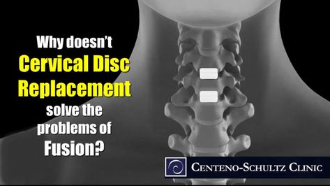 Why Cervical Disc Replacement Is No Better than a Fusion. Cervical Fusion, Cervical Disc, Neck Surgery, Cervical Spine, Spine Surgery, Growth Factor, Stem Cells, Neck Pain, Chronic Pain