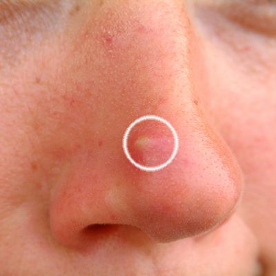 Quick and Effective Way to Remove White Head on Nose [Works] Make a paste of cornstarch and vinegar.  Apply to affected area, wait 15-30 mins, then rinse with warm water. White Heads On Nose, Pimple On Nose, How To Treat Pimples, Nodular Acne, Whiteheads Remedy, Nose Pimples, Varicose Vein Remedy, Blind Pimple, Pimples Under The Skin