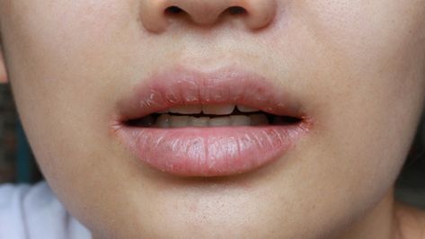 Cracked Lip Corners, Cracked Corners Of Mouth, Mouth Breather, Antifungal Cream, Cracked Lips, Your Lips, Skin Healing, Sciatica, Teeth Cleaning