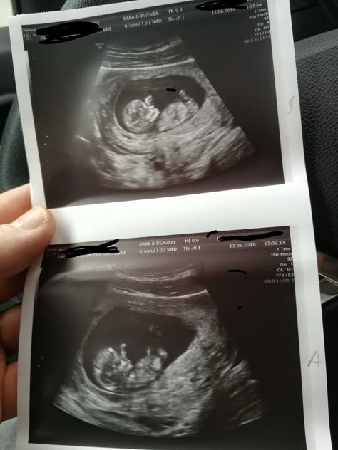 12 Week Ultrasound Pictures, Twins Ultrasound, Baby Ultrasound Pictures, First Baby Pictures, Pregnancy Belly Photos, Baby Ultrasound, Ultrasound Pictures, Baby Tumblr, Mommy Goals