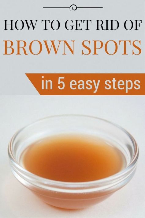 Simple Trick To Remove Brown Spots From Your Skin >>LEARN HOW<< Age Spot Remedies, Sun Spots On Skin, Black Spots On Face, Sunspots On Face, Spots On Forehead, Brown Spots On Hands, Brown Age Spots, Age Spot Removal, Brown Spots On Skin