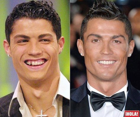 Christiano Ronaldo smile makeover - how the smile changes the outlook Ronaldo Young, After Braces, Bad Plastic Surgeries, Dental Advertising, Plastic Surgery Gone Wrong, Face Surgery, Veneers Teeth, Dental Braces, Teeth Straightening