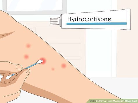 How To Soothe Mosquito Bites, How To Treat Mosquito Bits, How To Get Rid Of Bug Bites Fast, How To Heal Bug Bites Fast, How To Heal Mosquito Bites Fast, Heal Mosquito Bites Fast, Insect Bites Remedies, How To Get Rid Of Misquote Bites, How To Stop Mosquito Bites From Itching