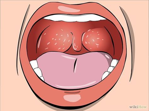 How to Tell if You Have Strep Throat Strep Throat Pictures, Throat Infection, Healthy Book, Strep Throat, Healing Tips, Dark Underarms, Health Signs, Health And Fitness Magazine, Migraine Headaches