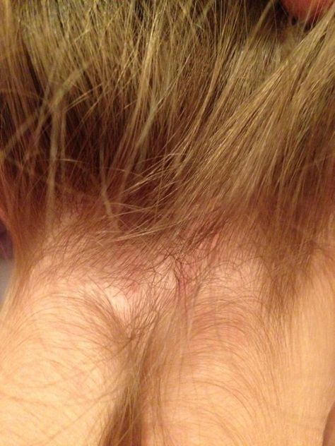 pictures of lice rashes-symptoms of lice Hair Lice, Lice Removal, Myths And Facts, Head Louse, Low Bun Hairstyles, Natural Healing Remedies, Low Bun, Life Advice, Herbal Remedies