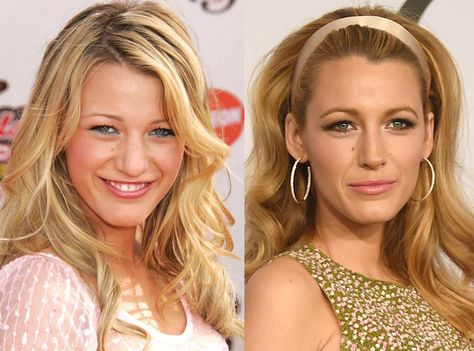 Photos from Celebs Who Deny Getting Plastic Surgery - E! Online Blake Lively Nose, Cheek Implants, Rhinoplasty Nose Jobs, Facial Fillers, In Denial, Nose Surgery, Celebrity Plastic Surgery, Under The Knife, Celebrities Before And After