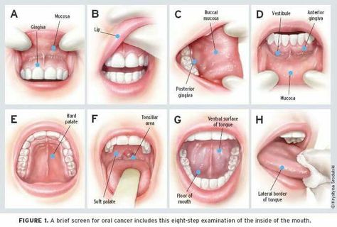 Surgical Oncology, Canker Sore, Types Of Cancers, Oral Health, Dental Care