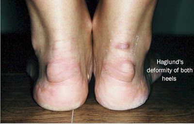 If you’ve noticed a lump right above your heel that’s red and sore and gets worse when you walk or run in shoes, you might have Haglund’s Deformity, also known as “pump bump… Bone Spur On Back Of Heel, Heel Spur Symptoms, Heal Spurs, Heel Spur Relief, Haglunds Deformity, Achilles Tendinopathy, Achilles Pain, Lower Back Pain Remedies, Sore Hips