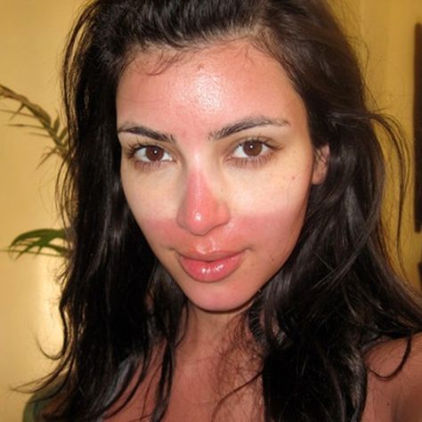 Cute Sunburn Face, Sunburn Aesthetic Face, Sunburn Face Remedy, How To Treat Sunburn On Face, Cute Sunburn, Sunburn Makeup Look, Sunburn Aesthetic, Sunburned Face, Sunburn Makeup