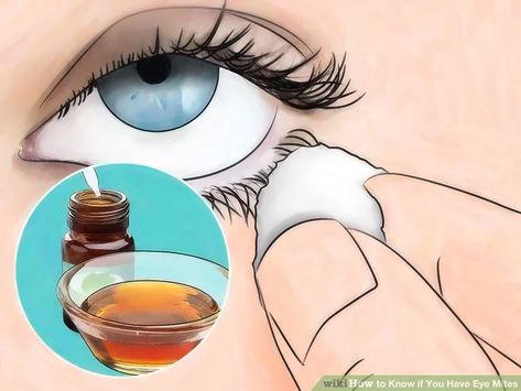 Itchy Eyes Remedy, Eye Mites, Itchy Eyelids, Eye Health Remedies, Eye Stye Remedies, Demodex Mites, Allergy Eyes, Tea Tree Oil Shampoo, Droopy Eyelids