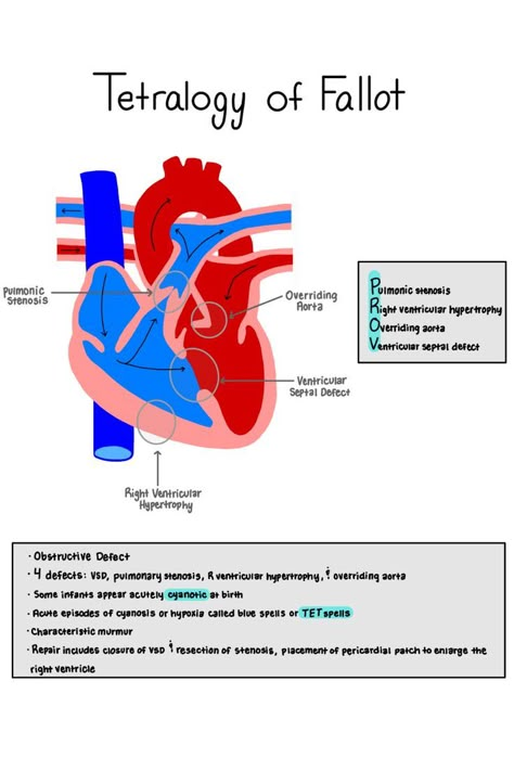 Tetralogy Of Fallot Mnemonic, Pediatric Cardiac Nursing Congenital Heart Defect, Tetralogy Of Fallot Nursing, Congenital Heart Defect Nursing, Dvt Nursing, Nurse Vocabulary, Tetralogy Of Fallot, Respiratory Therapist Student, Pediatric Cardiology