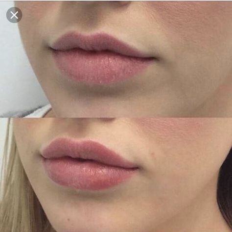 Bee stung Lips Claim, Bee Stung Lips, Lip Goals, Dermal Fillers Lips, Lips Inspiration, Botox Lips, Face Surgery, Lip Augmentation, Facial Aesthetics