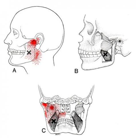 Odd Symptoms, Punkty Spustowe, Sternocleidomastoid Muscle, Myofascial Pain Syndrome, Medical Symptoms, Referred Pain, Sinus Pain, Chiropractic Wellness, Trigger Point Therapy