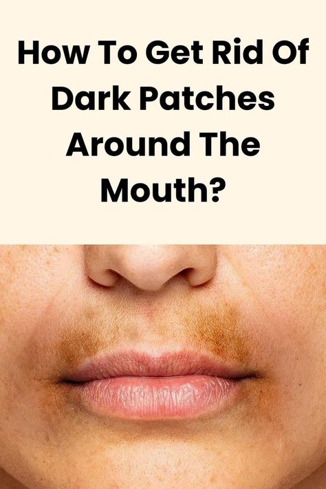 Want to get rid of darkness around the mouth? Here’s what best you can do for your skin for reducing dark patches and hyperpigmentation around your mouth. Get Rid Of Darkness Around Mouth, How To Get Rid Of Dark Spots Around Mouth, How To Get Rid Of Hyperpigmentation Around The Mouth, How To Get Rid Of Dark Skin Around Mouth, How To Get Rid Of Discoloration Skin, Remove Hyperpigmentation Around Mouth, How To Remove Darkness Around Mouth, Dark Spots Around Mouth, How To Get Rid Of Hyperpigmentation