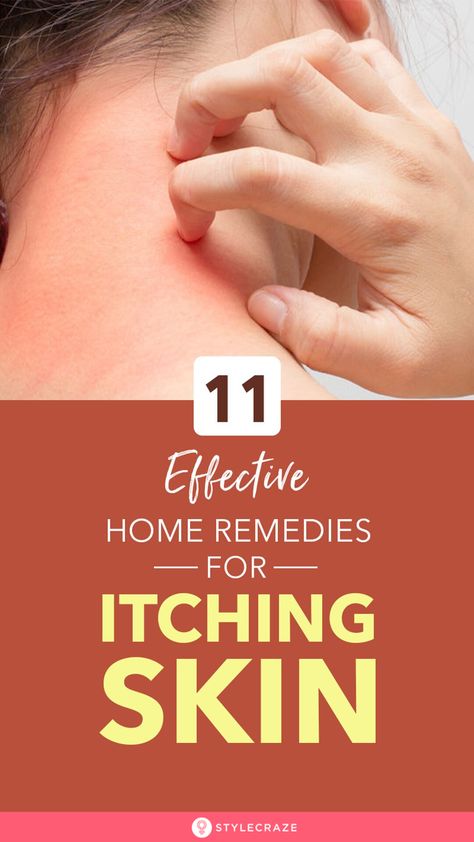 Itching Skin Remedies, Dry Itchy Skin Remedies, Remedies For Itchy Skin, Skin Rash Remedies, Itching Remedies, Itch Relief Skin, Itchy Body, Itchy Skin Rash, Itchy Skin Remedy