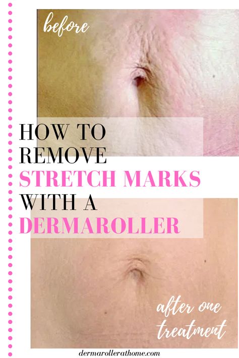 Dermarolling Loose Skin, Mom Belly Before And After, Stretch Mark Removal Before And After, Dermarolling Before And After, Stretch Mark Microneedling, Dermarolling Stomach, Dermaroller Before And After, Dermapen Before And After, Micro Needling Before And After