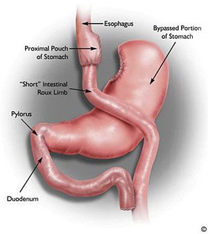 What is Roux-en-Y Gastric Bypass surgery (Bariatric Surgery)? Bariatric Dinner, Gastric Bypass Recipes, Gastric Band, Bariatric Surgeon, Bariatric Diet, Sleeve Gastrectomy, Sleeve Surgery, Bariatric Eating, Psychological Effects