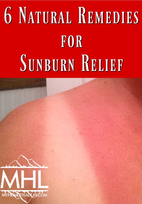 Vinegar For Sunburn, Sunburn Blisters, Treating Shingles, Home Remedies For Sunburn, Aloe Vera For Sunburn, Natural Remedies For Sunburn, Bad Sunburn, Sunburn Skin, Sunburn Remedies