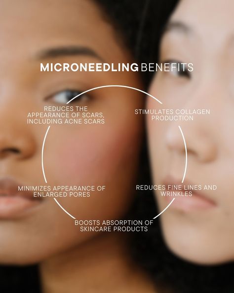 🌟 Small steps, big results! 🌟 Microneedling works wonders by targeting those stubborn skin concerns, from acne scars to fine lines.  #MicroneedlingMagic #SkinRenewal #HerWayHealth #FreshFace #SkinRevival Esthetician Marketing Small Businesses, Microneedling Aesthetic, Microneedling Before And After, Microneedling After Care Instructions, What Is Microneedling, Microneedling Depth Chart, Microneedling After Care, Microneedling Promotion, Aesthetics Nurse