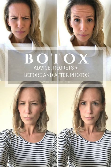 Botox: Advice, Regrets And Before + After | my kind of sweet | fillers | beauty blogger | mom life | beauty | mom style | botox forehead Botox At Home, Botox Eyes, Botox Forehead, Botox Results, Botox Brow Lift, Botox Before And After, Eyebrow Lift, Botox Alternative, Botox Face