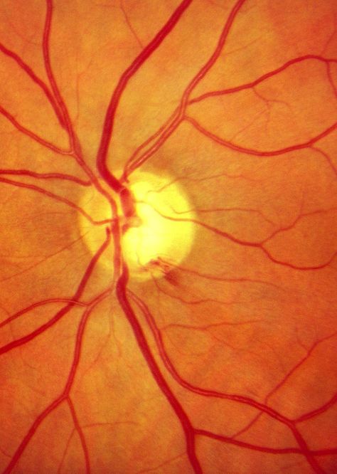 Optic nerve hemorrhage can be a sign of worsening glaucoma with loss of nerve fibers. Diagram Of The Eye, Optician Training, Eye Nerves, Optometry Education, Swollen Eyelid, Element Project, Microscopic Photography, Medical Photography, Optic Nerve