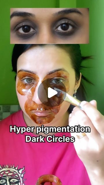 Neha Mandal on Instagram: "Hyper pigmentation & Dark circles 
.
.
Ingredients 👇🏻

1 tbsp Coffee
1 tbsp fresh potato juice
1 tbsp Honey
.
.
.
#hyperpigmentation #hyperpigmentationtreatment #darkcircles #darkcirclesundereyes #darkcircle #darkcircleremoval #remedies #remedies #homeremedies #hack #diymask #diymasks #skinbrightening #skinbreakout #skinglow #naturalglow #beauty #beautytips #reelsinstagram #reelitfeelit #trendingsongs #explorar #explorepage✨ #explorepage #explorer #exploring #exploremore #exploreeverything #trendingaudio #beautyhacks #koreanmask" Pigmentation Remedy, Korean Mask, Skin Breaking Out, Potato Juice, Hyper Pigmentation, Fresh Potato, Remove Dark Circles, Dark Circles Under Eyes, Trending Songs