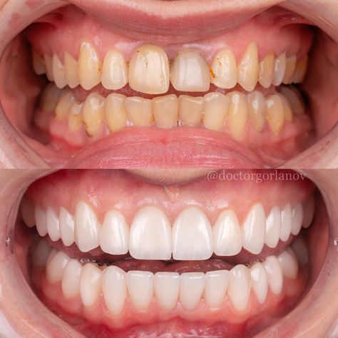 Esthetic Procedures, Teeth Makeover, Dentist Aesthetic, Dental Makeover, Dental Aesthetic, Face Plastic Surgery, Cosmetic Dentistry Veneers, Cosmetic Dentistry Procedures, Alcohol Free Mouthwash