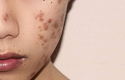 Hyperpigmentation: Causes, Symptoms, Types, And Treatments Layer Skincare, Blind Pimple, Post Inflammatory Hyperpigmentation, Treating Hyperpigmentation, Cbd Oil Benefits, Best Face Wash, Types Of Acne, Skincare Blog, Get Rid Of Acne