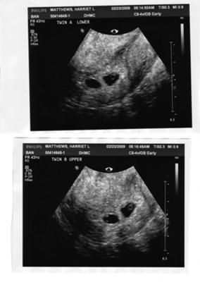 Triplets Ultrasound Pictures, 3 Weeks Pregnant Ultrasound Twins, Usg Pregnancy Twins, Twin Ultrasound 6 Weeks, Twins Manifestation, 3 Weeks Pregnant Ultrasound, 5 Week Ultrasound Pictures, 4 Weeks Pregnant Ultrasound, 7 Weeks Pregnant Ultrasound