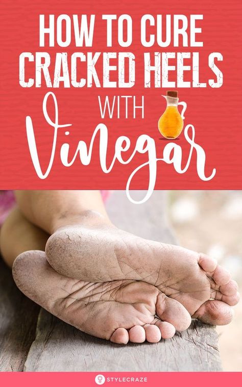 Vinegar Scrub For Dry, Rough, And Cracked Heels Soften Heels Diy, Cracked Feet Remedies Heels, How To Soften Heels, How To Soften Feet Heels, How To Get Rid Of Rough Heels, How To Get Rid Of Crusty Heels, Rough Feet Remedy, Rough Feet Remedy Heels, Healing Cracked Heels