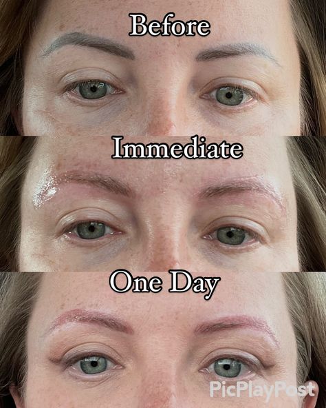 Progress pics of my brow removal 💕 #eyebrows #lasertattooremoval #tattooremoval #permanentmakeup #cosmetictattoo #paramedicaltattoo #powderbrows #microblading Laser Tattoo Removal, Cosmetic Tattoo, Tattoo Removal, Progress Pictures, Permanent Makeup, Microblading, Eyebrows