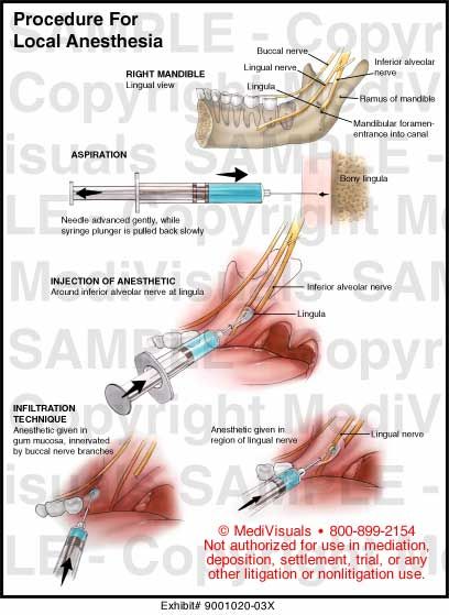 Local anesthesia in dentistry Local Anaesthesia In Dentistry, Dental Local Anesthesia, Dental Anesthesia Injection Sites, Local Anesthesia Dental Hygiene, Local Anesthesia Dental, Dental Anesthesia, Dental Infographics, Dental Assistant School, Local Anesthesia