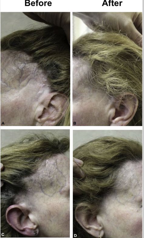 Frontal Fibrosing Alopecia (FFA): Is there a case for preventing further loss? — Donovan Hair Clinic Frontal Fibrosing Alopecia, Question Of The Week, B And D, Alopecia Hairstyles, Scientific Diagram, Hair Clinic, Ffa, Hair Density, Functional Medicine