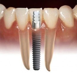 Free Dental Implants, Bristol Ri, Affordable Dental Implants, Best Dental Implants, Dental Implant Surgery, Kedokteran Gigi, Dental Implants Cost, Implant Dentistry, Teeth Implants