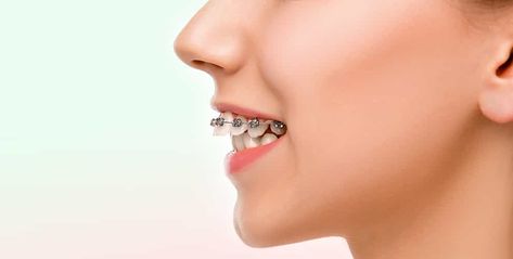 How To Fix Overbite At Home, Overbite Teeth, Fix Overbite, Extra Teeth, Rotten Teeth, Teeth Remedies, Misaligned Teeth, Buck Teeth, Dental Fillings