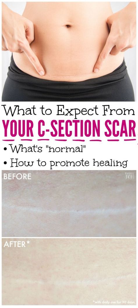 C Section Scar, C Section Scars, Emotional Eater, Cold Sore Remedies, C Section Recovery, Scar Cream, Skip Breakfast, Home Remedy For Cough, Skin Natural Remedies