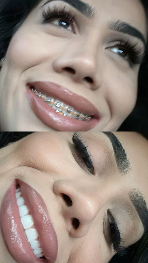 Before and after braces #braces #bracesbeforeandafter #straightener #straightteeth #smile #whitening Braces Before And After Overbite, Braces Removal, Braces Kit, Before And After Braces, Braces Before And After, After Braces, Nursing Quotes, Straight Teeth, Nurse Quotes